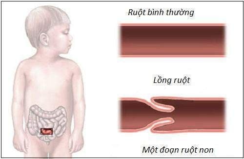 
Lồng ruột ở trẻ
