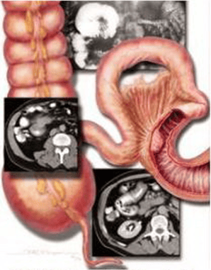 
Hình 3: Các vị trí thường gặp của u dạng carcinoid ở đường tiêu hoá
