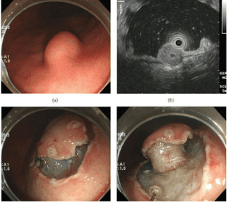 
Hình 5: Một tổn thương u carcinoid được cắt bỏ qua nội soi
