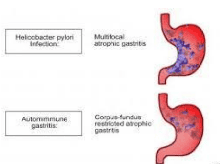 
Hình ảnh viêm teo chủ yếu ở đáy vị và thân vị, trong khi trong viêm dạ dày do H.Pylori, viêm teo chủ yếu xảy ra ở hang vị và góc bờ cong nhỏ
