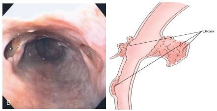 
Viêm thực quản do Cytomegalovirus
