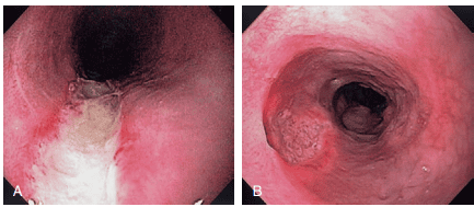 
Viêm thực quản do Cytomegalovirus
