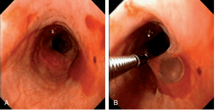 
Viêm thực quản dạng bóng nước (bệnh Pemphigus)
