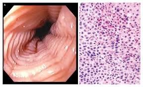 Eosinophilia and eosinophilic esophagitis