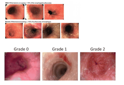 
Hình ảnh các các mảng, đám xuất tiết trên nội soi của VTQBCAT và phân độ theo thang điểm EREFS (Endoscopic Reference Score): độ 0: các các mảng, đám xuất tiết không rõ, độ 2: có rất nhiều các mảng, đám xuất tiết dọc theo chiều dài thực quản (Nguồn ảnh: researchgate.net)
