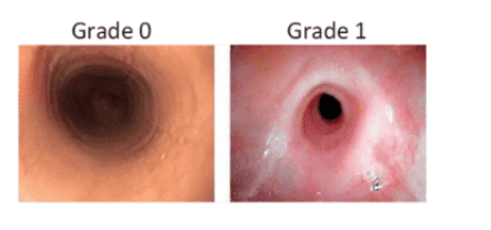 
Hình ảnh hẹp thực quản trên nội soi của VTQBCAT và phân độ theo thang điểm EREFS (Endoscopic Reference Score): độ 0: không hẹp, độ 1: Hẹp thực quản (Nguồn ảnh: researchgate.net)
