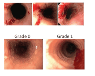 
Hình ảnh thực quản mỏng như giấy trên nội soi của VTQBCAT và phân độ theo thang điểm EREFS (Endoscopic Reference Score) (Nguồn ảnh: researchgate.net)
