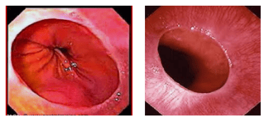 
Hình ảnh Vòng Schatzki trên nội soi thực quản – dạ dày
