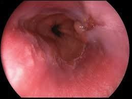 Endoscopic diagnosis of eosinophilic esophagitis