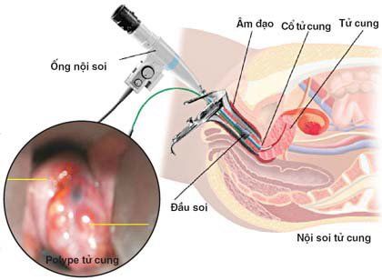 Steps to perform colposcopy