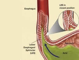 
Hình 5: Bệnh lý viêm thực quản trào ngược cũng gây nên tình trạng xuất hiện bạch cầu ái toan tại thực quản
