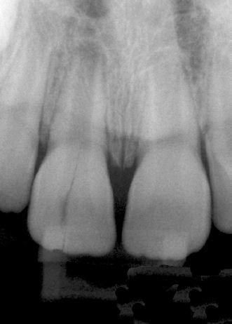 Root cracks and fractures: Clinical features and classification