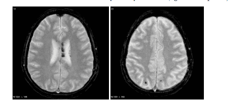 
Xung T2* ở bệnh nhân DAI (nguồn Radiopaedia)
