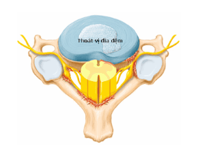 
Thoát vị đĩa đệm đốt sống cổ
