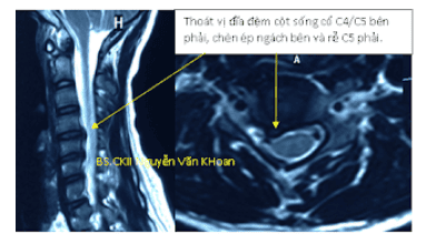 
Chụp cộng hưởng từ được xem là xét nghiệm có giá trị như một “tiêu chuẩn vàng” trong chẩn đoán thoát vị đĩa đệm.
