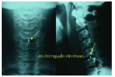 
Phẫu thuật cắt đĩa C5/C6 giải ép, đặc nêm PEEK lối trước. Sau mổ bệnh nhân hết đau, trở lại sinh hoạt bình thường sau 2 tháng.
