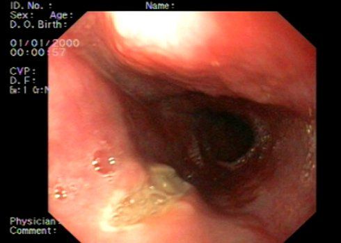 Endoscopic interventional treatment of eosinophilic esophagitis