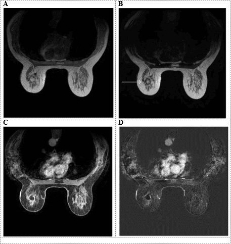 
Hình (A) T1W, (B) T2W, (C) T1W sau tiêm gadolinium, (D) T1W sau tiêm gadolinium sau subtraction: Khối ở vú trái có tín hiệu mỡ trên các chuỗi xung.
