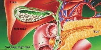 Endoscopic stenting to treat biliary obstruction due to stones