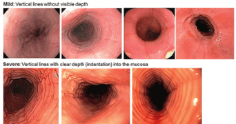 
Hình 2: Hình ảnh các rãnh dọc thực quản trên nội soi của VTQBCAT
