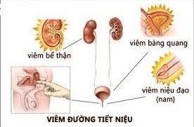 
Thuốc viêm đường tiết niệu có hiệu quả tốt trong điều trị viêm đường tiết niệu
