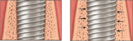 
Khi trụ implant tích hợp với xương hàm sẽ tạo nền tảng vững chắc cho phục hình răng giả gắn lên trên
