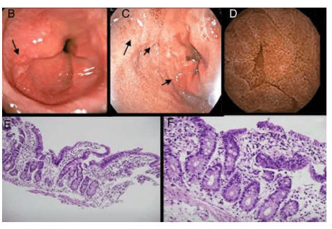 How is eosinophilic gastroenteritis formed?