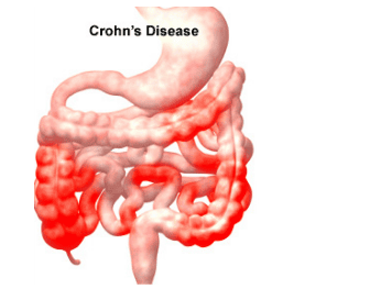 Gastrointestinal damage of Crohn's disease