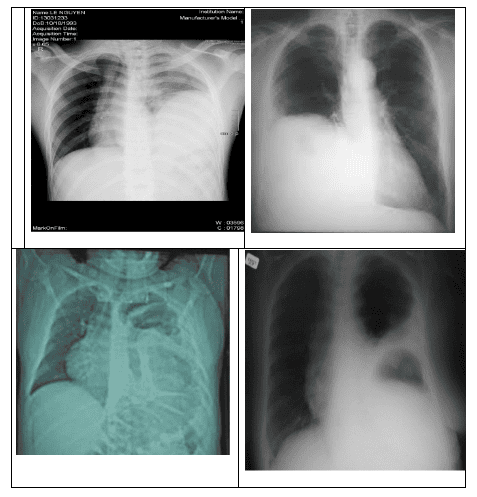 Trauma to the chest caused a rupture of the diaphragm