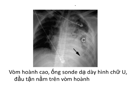 
Dấu hiệu CT scanner
