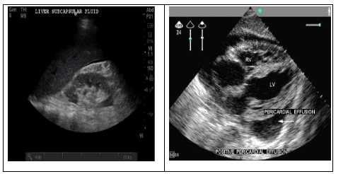 Trauma to the chest caused a rupture of the diaphragm