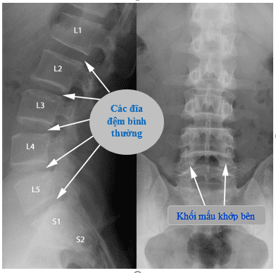 
Khi chụp X - quang cột sống có thể thấy được tình trạng mất đường cong sinh lý trong một số bệnh, kết hợp với các dấu hiệu khác đưa ra chẩn đoán bệnh.
