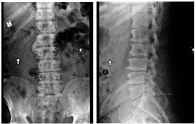 
X quang: Mất đường cong sinh lý cột sống thắt lưng do thoái hoá. Cột sống thắt lưng hơi bị còng đoạn từ đốt sống L1 đến L3 thay vì cong ưỡn ra trước.
