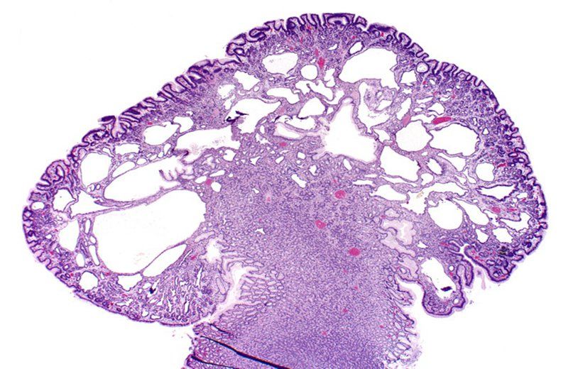 Some rare gastric epithelial polyps | Vinmec