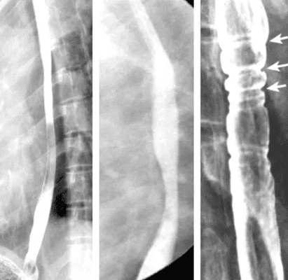 
Hình 9: Hẹp lan tỏa, co thắt thực quản và vòng tròn đồng tâm (Nguồn: radiologykey.com)
