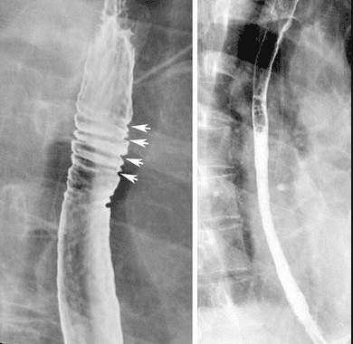 
Hình 6: Hình ảnh các vòng thực quản trên chụp Baryt ở một bệnh nhân bị viêm thực quản bạch cầu ái toan (Nguồn: abdominalkey.com)
