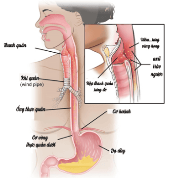 
Hình 1: Thực quản là một ống cơ nối từ miệng đến dạ dày
