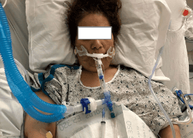 Treatment of acute respiratory distress syndrome - ARDS