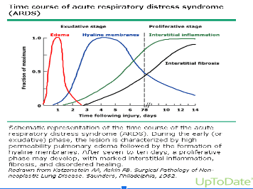 
Các giai đoạn ARDS
