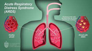 Critical respiratory syndrome and pathogenesis