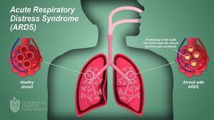 Hội chứng nguy kịch hô hấp và bệnh sinh