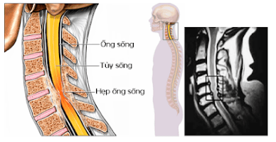 Degenerative cervical myelopathy - What you need to know