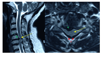 
Hình ảnh cộng hưởng từ (MRI) đánh giá mức độ hẹp ống sống
