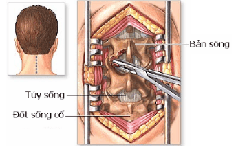 
Phương pháp cắt bản sống lối sau
