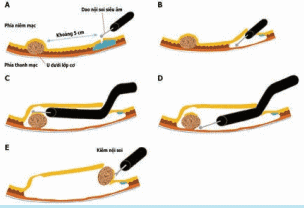 
Cắt bỏ u nội soi qua đường hầm dưới niêm mạc
