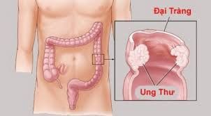 Colon and rectal cancer