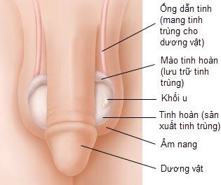 
Dấu hiệu ung thư tinh hoàn hay gặp nhất là bệnh nhân tự phát hiện thấy bìu to
