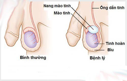 
Siêu âm bìu phát hiện được 75% khối u
