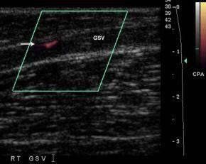
Doppler màu cắt dọc tĩnh mạch hiển lớn bị huyết khối chỉ thấy một dòng chảy nhỏ ở ngoại vi (mũi tên)
