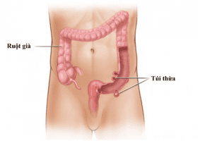 
Bệnh túi thừa biểu hiện bởi những túi phình ra từ đại tràng
